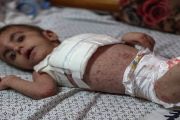 الأمراض الجلدية تنتشر بين أطفال غزة